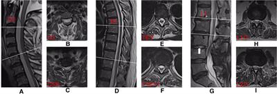 Extensive spinal epidural abscess caused by Staphylococcus epidermidis: A case report and literature review